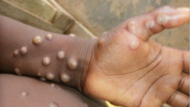 Monkeypox Outbreak: 11 देशांमध्ये मंकीपॉक्सच्या 80 संक्रमित  रुग्णांची नोंद